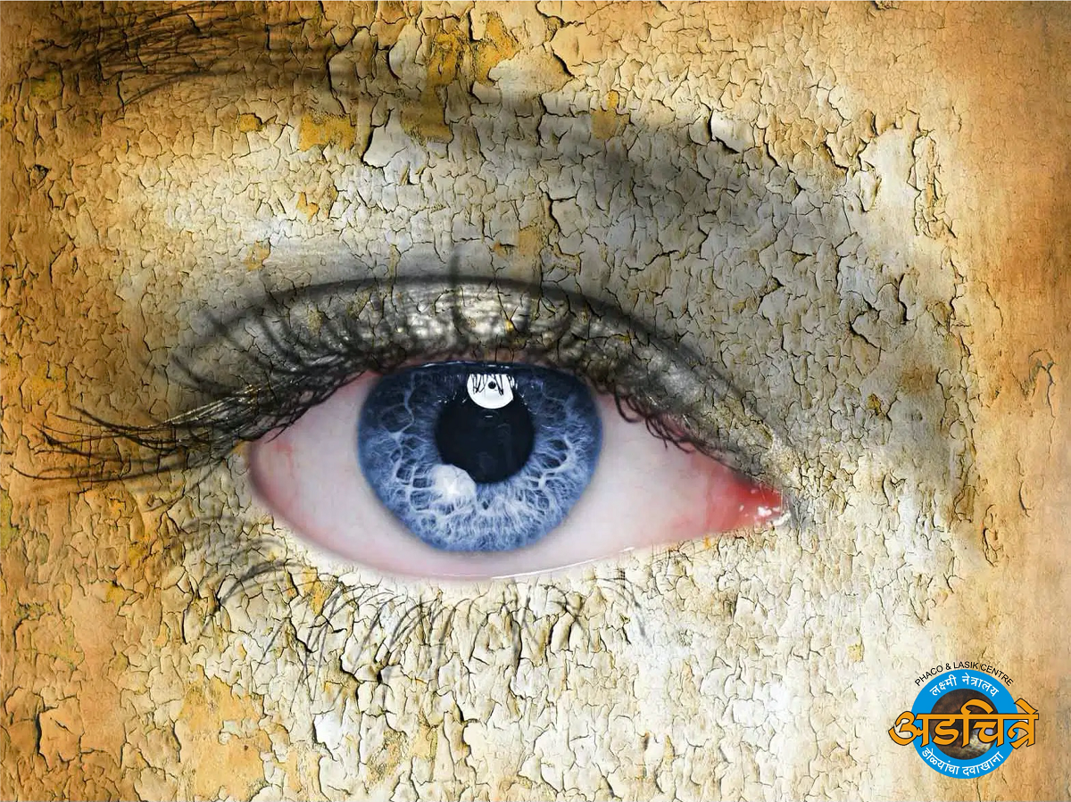 Dry Eye Care