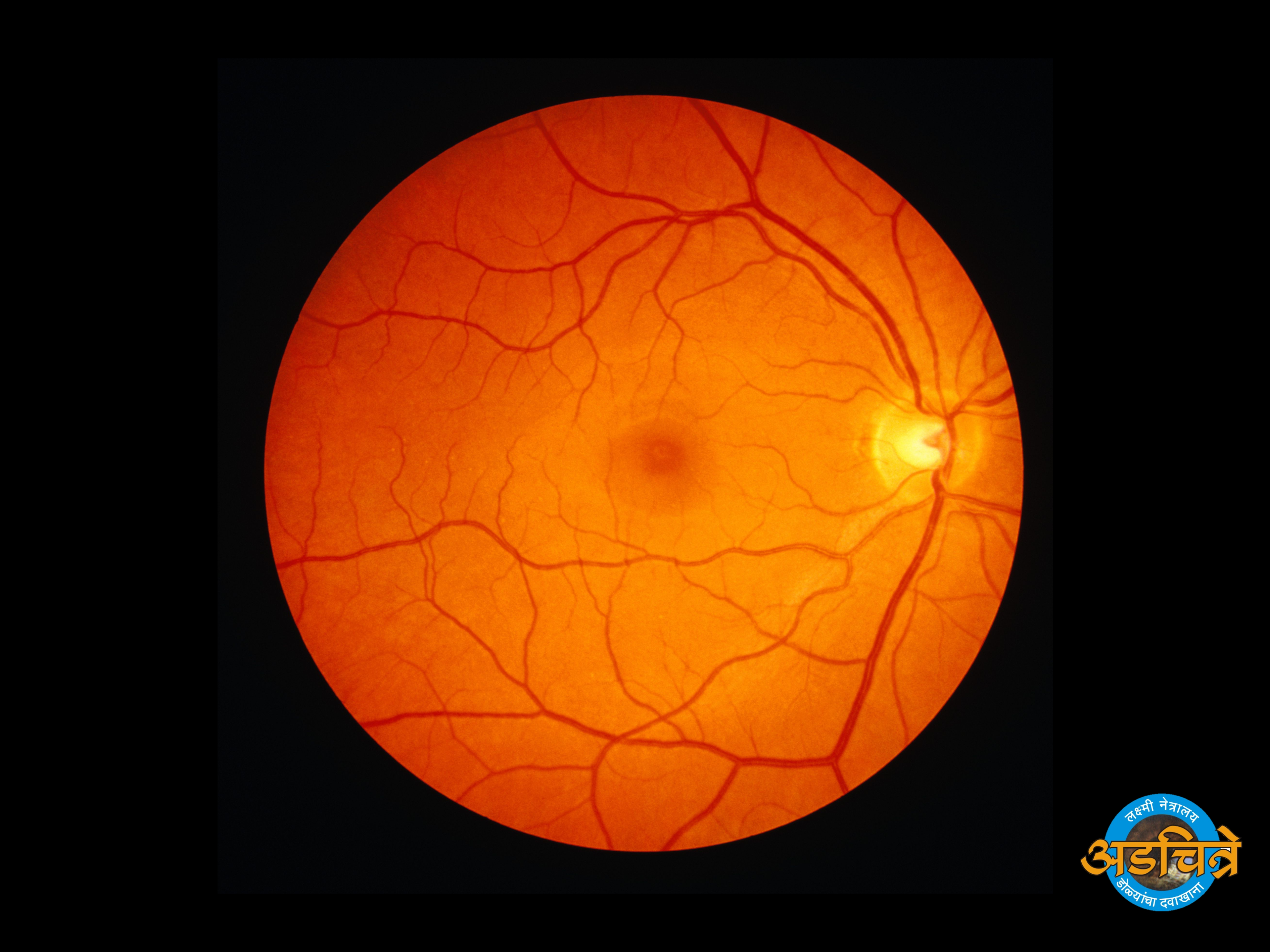 Retina