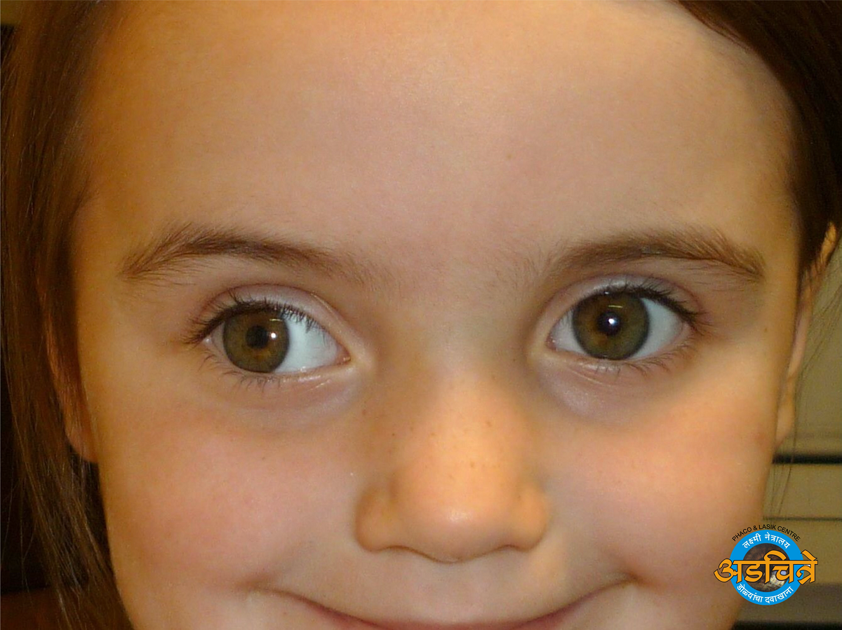 Children Squint eye treatment in Aurangabad